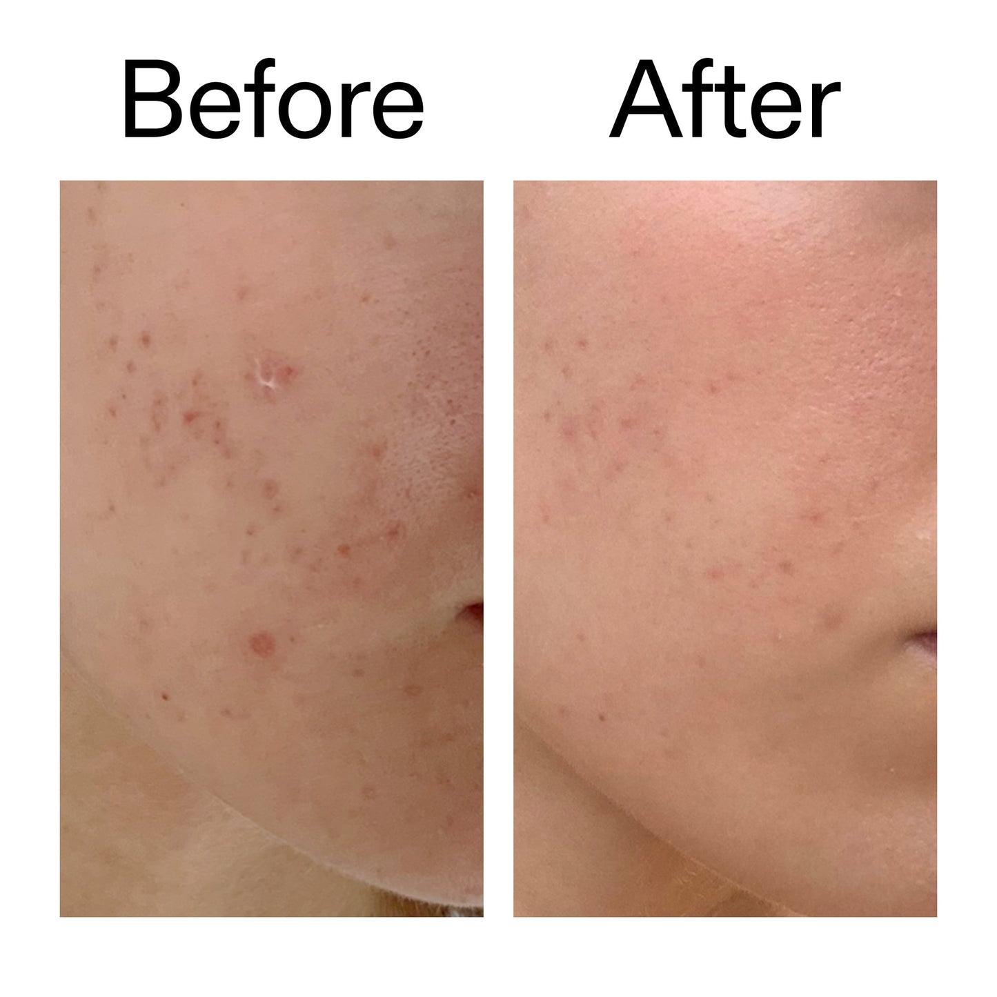 mandelic-acid-treatment-g0 Mandelic_Acid_Treatment_Before_After_2000x2000_4885ac6e-c5d7-4279-a72a-1417af7dce35.jpg