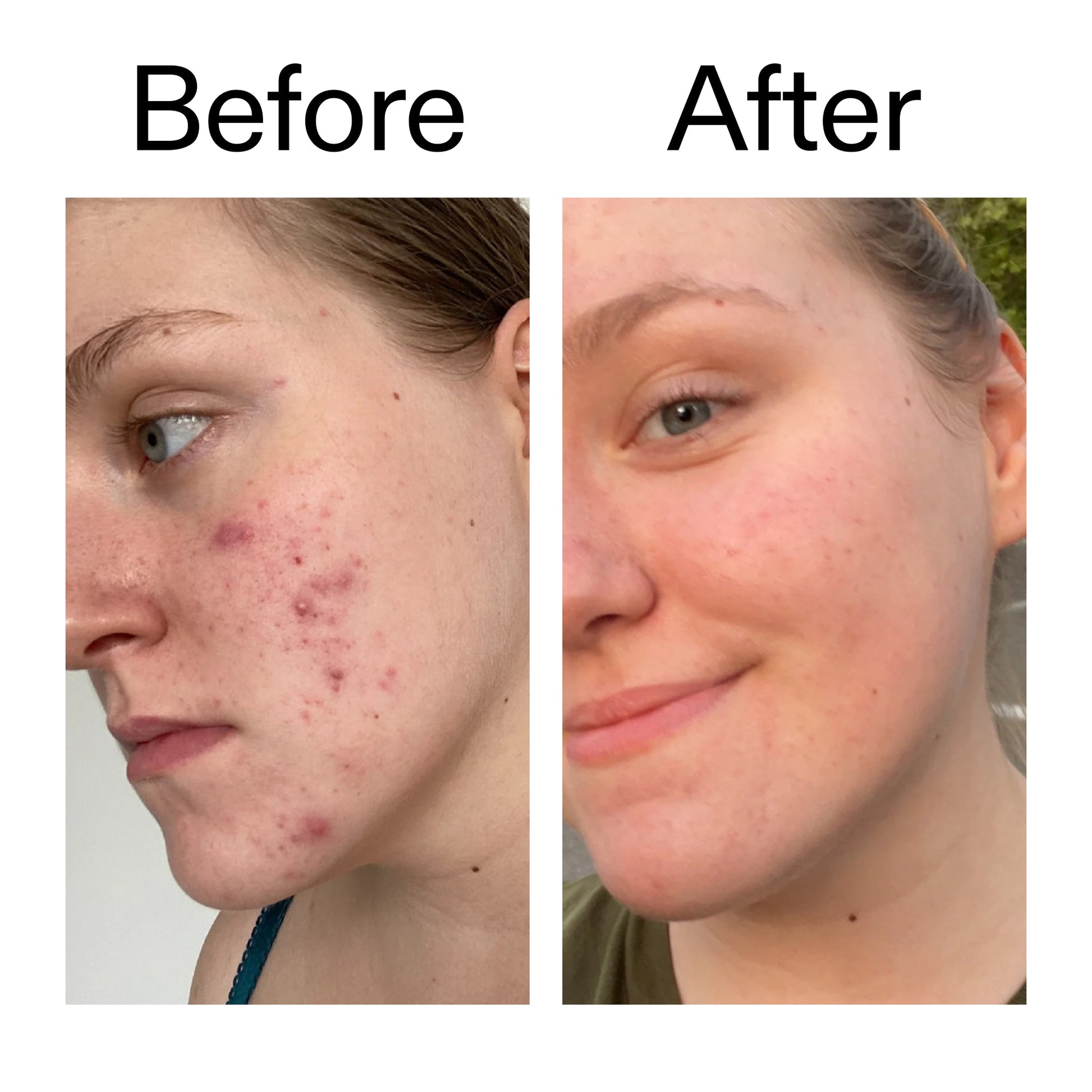 15-vitamin-c-egf-serum-o6 15_Vitamin_C_EGF_Serum_Before_After_2000x2000_fb9f598a-3386-40c8-8143-36f9d7a17ec8.jpg