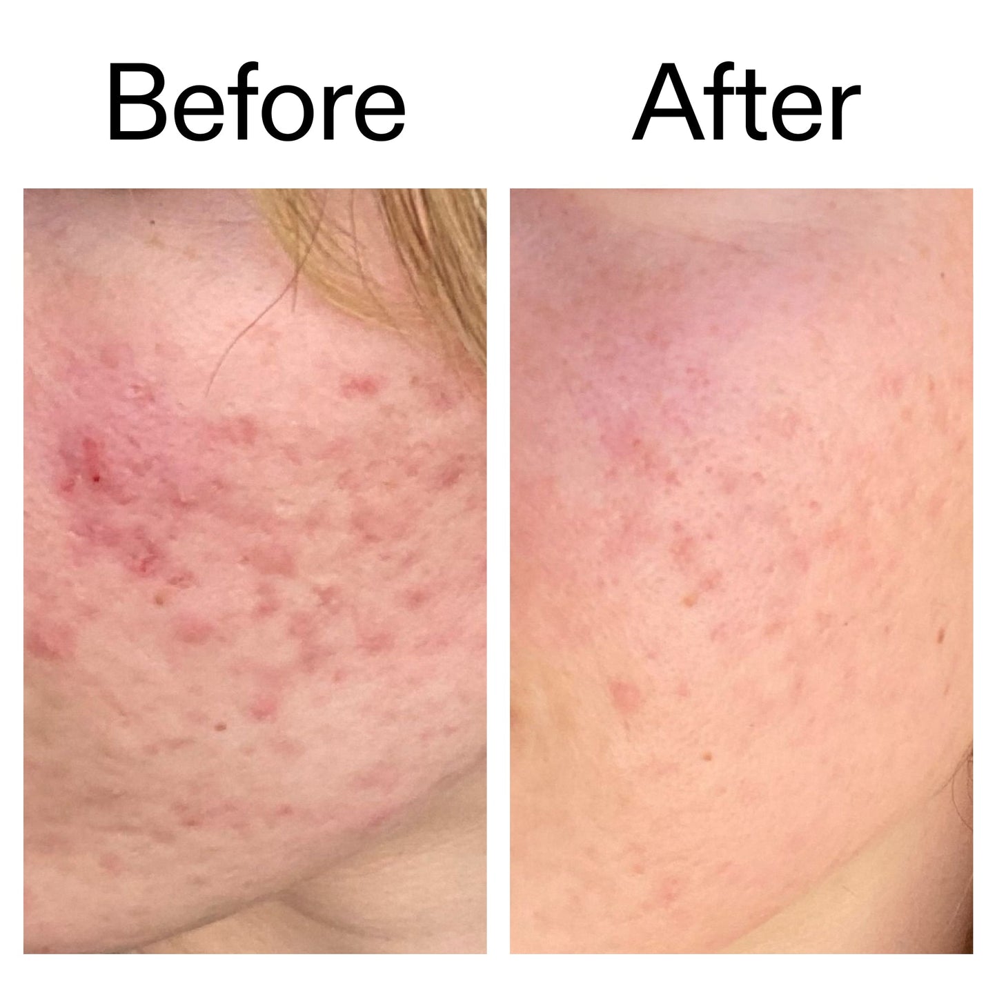 10-azelaic-acid-serum-for-redness-relief-d4 Azealic_Acid_Serum_B_A_Ppage_2000_x_2000.jpg