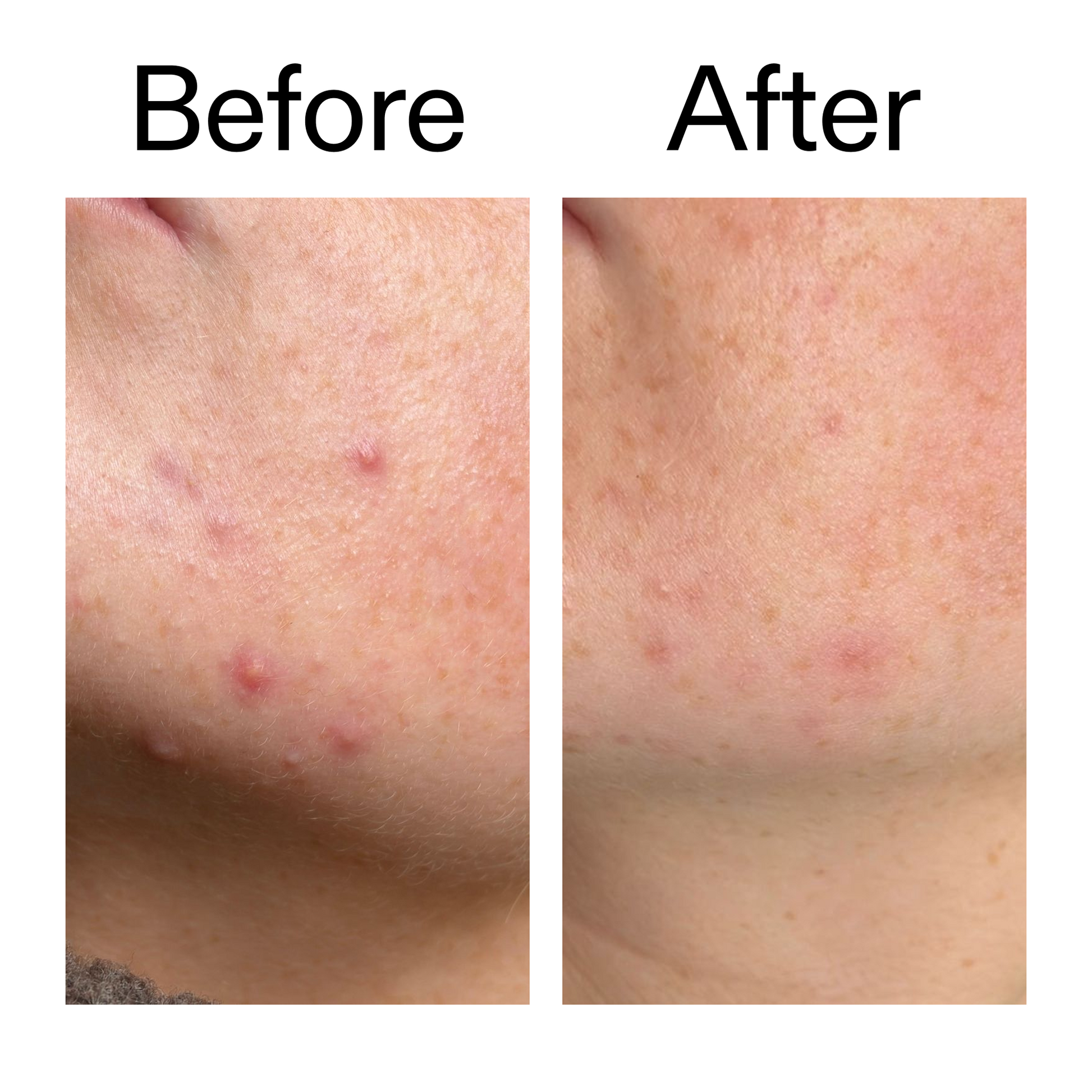 10-azelaic-acid-serum-for-redness-relief-d4 B_A_1_PPAGE.png