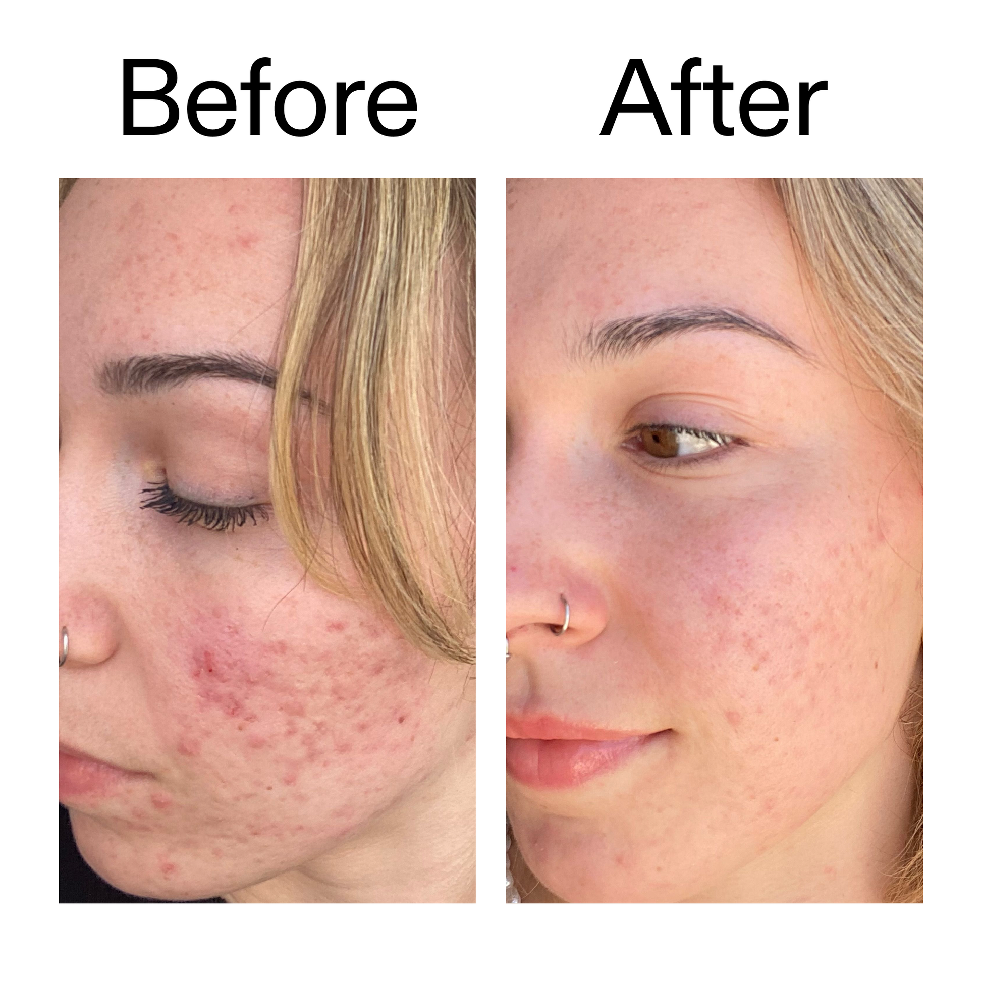 10-azelaic-acid-serum-for-redness-relief-d4 B_A_2_PPAGE.png