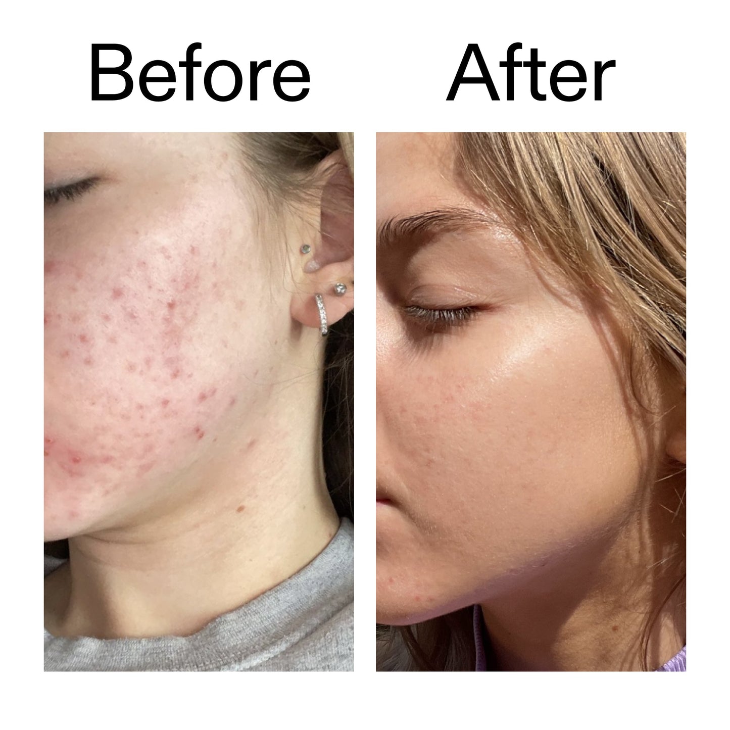 beta-hydroxy-acid-bha-serum-u0 Beta_Hydroxy_Acid_Serum_Before_After_2000x2000_96fda3e5-938d-49ef-bcf2-a0fa6ece4e2c.jpg