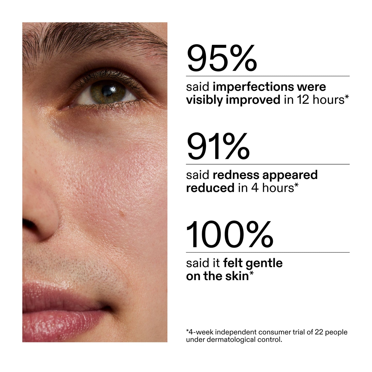 succinic-acid-acne-treatment-u5 CA_Succinic_Acid_Treatment_key_Claims_2000x2000_db91b0f1-7f29-4bfe-bb16-63a47f500960.jpg