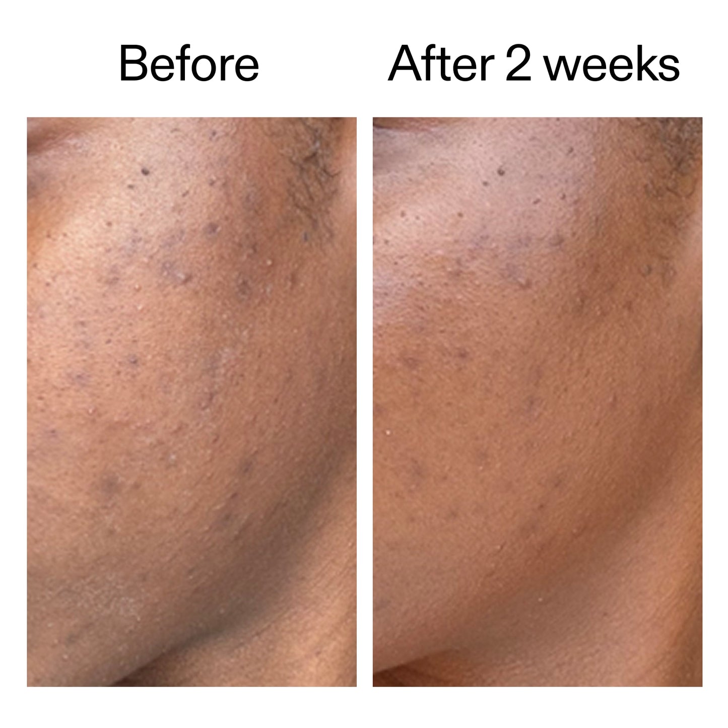 360-acne-clearing-serum-u2 DIOICB_A2000x2000.jpg