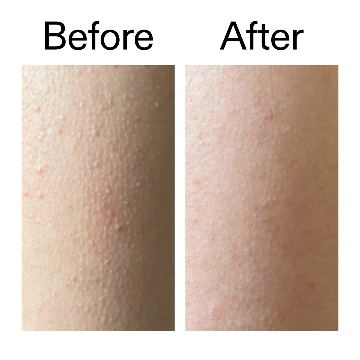glycolic-acid-exfoliating-body-stick-duo-n3 Glycolic_Acid_Exfoliating_Body_Stick_Before_After_V2_2000x2000_2e4ba052-94f6-4d56-82df-7bdb5b2df7ae.jpg