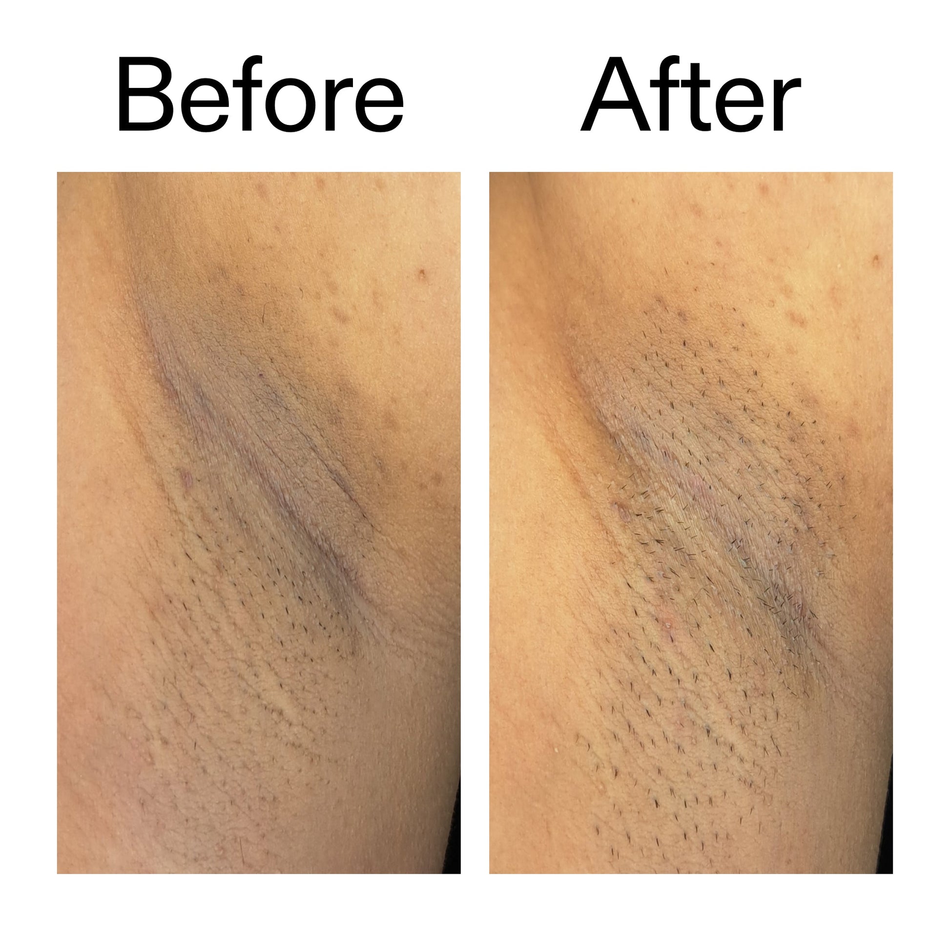 glycolic-acid-exfoliating-body-stick-duo-n3 Glycolic_Acid_Exfoliating_Body_Stick_Before_After_V3_2000x2000_ea919cd9-1439-4a46-82a0-76200eb5bb42.jpg