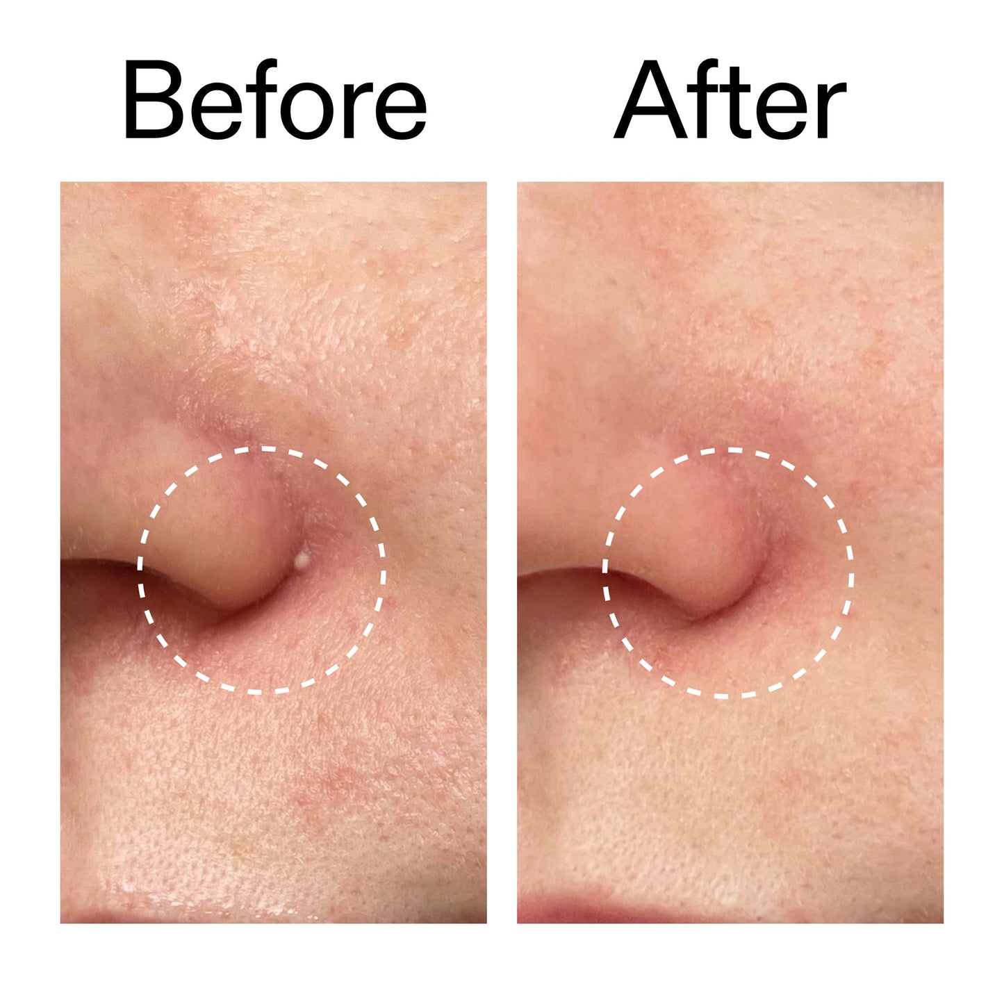 hydrocolloid-invisible-pimple-patches-pack-of-44-o9 Hydrocolloid_Invisible_Pimple_Patches_Before_After_2000x2000_b02aa37b-c78a-4682-91de-9135af5bb7df.jpg