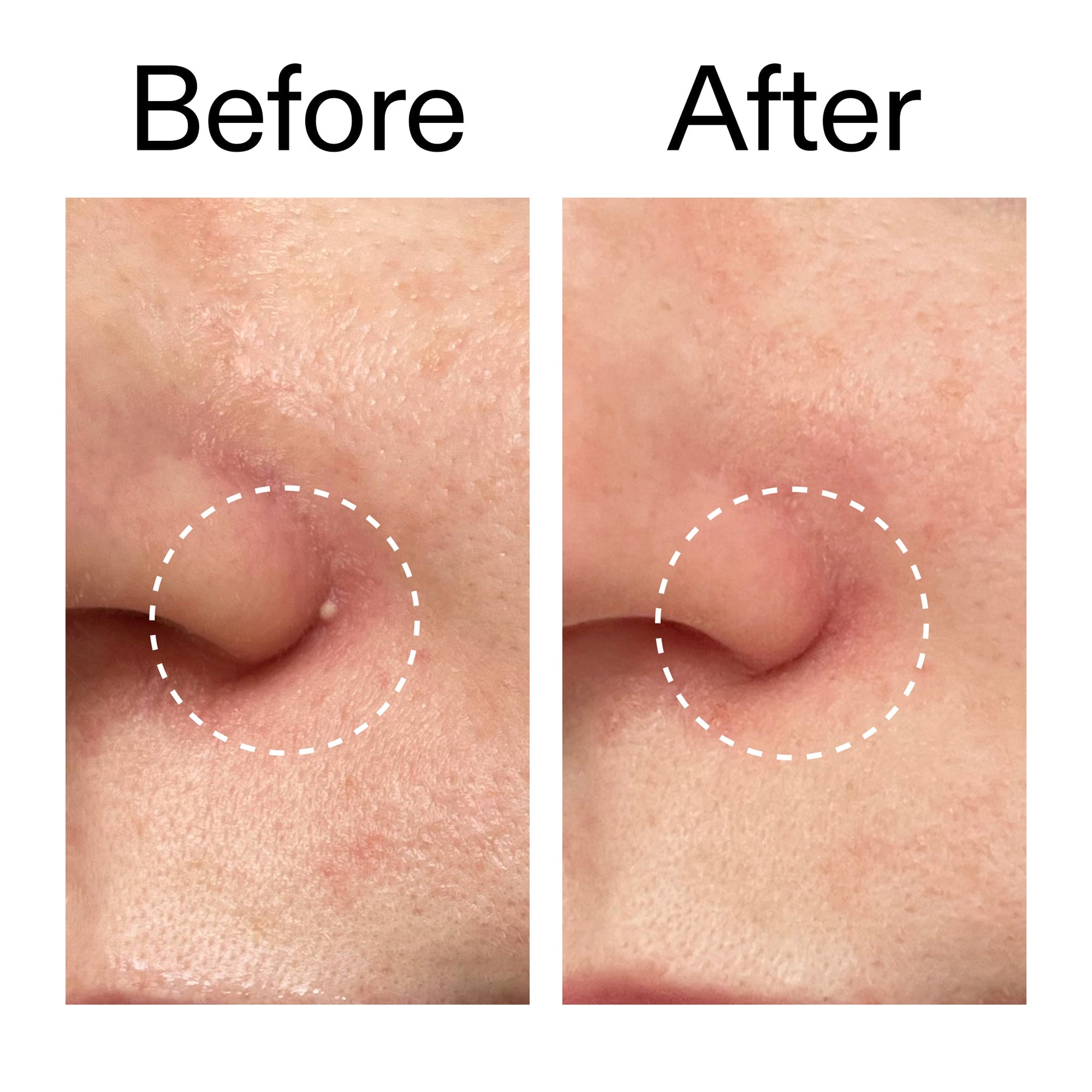 hydrocolloid-invisible-pimple-patches-pack-of-44-o9 Hydrocolloid_Invisible_Pimple_Patches_Before_After_2000x2000_b02aa37b-c78a-4682-91de-9135af5bb7df.jpg