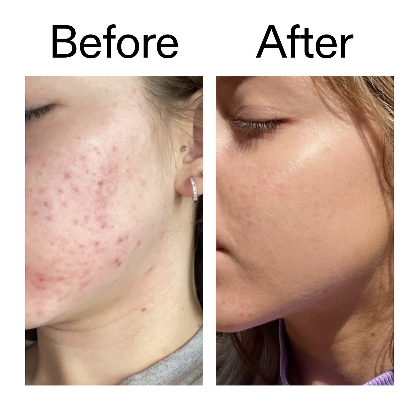 10-niacinamide-serum-duo-n7 Niacinamide_Serum_Before_After_2000x2000_bde32455-9e7d-448e-b053-bef41504f0a9.jpg