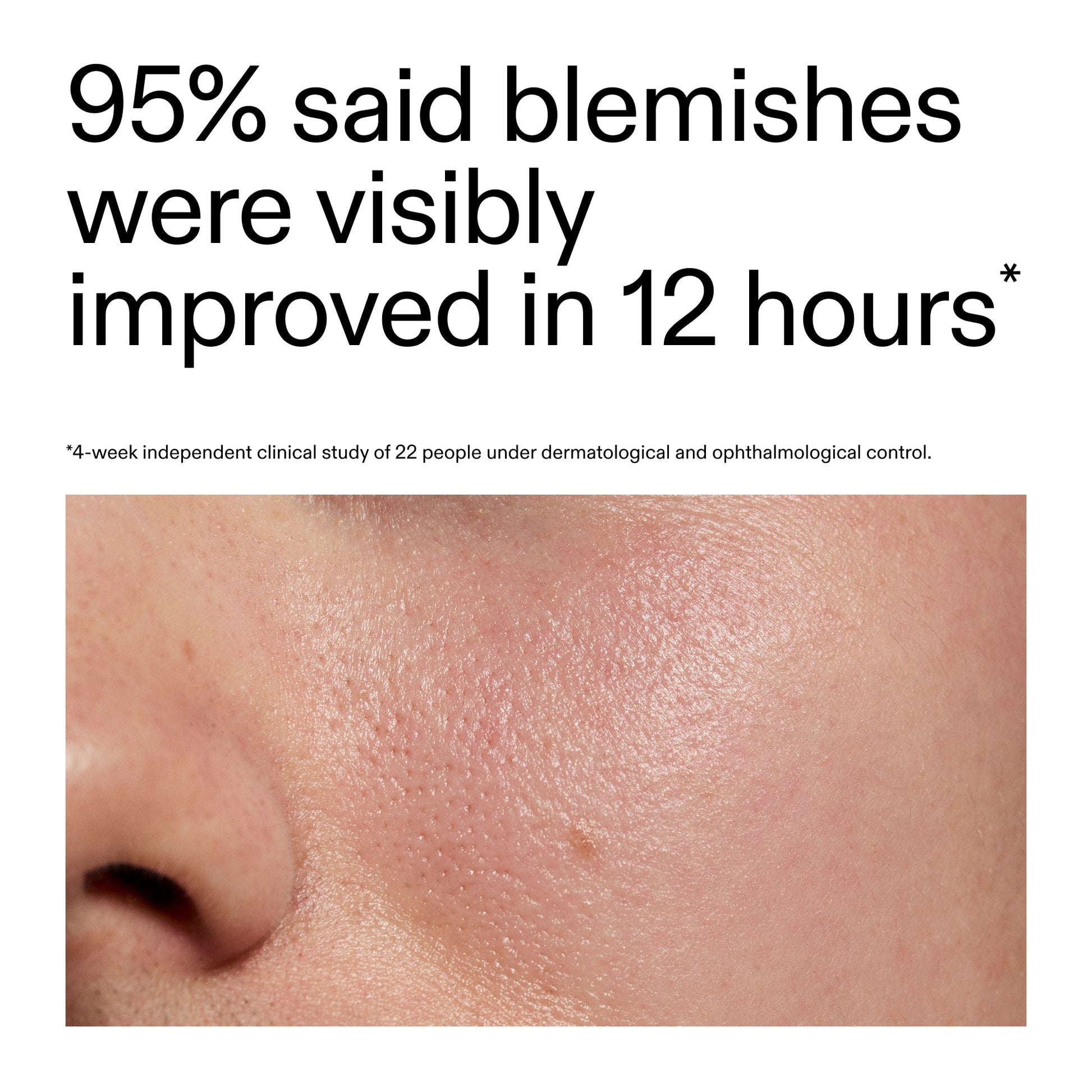 succinic-acid-acne-treatment-u5 Oat_Cleansing_Balm_Claim_2000x2000_ac6ce553-25db-41b2-a981-faae1ac4b8c0.jpg