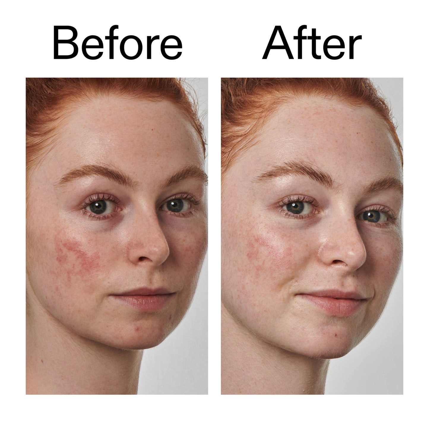 10-azelaic-acid-serum-for-redness-relief-d4 Redness_Relief_Serum_Before_After_2000x2000_3334dc9a-cce9-4e00-8aec-7ad89ca051f2.jpg