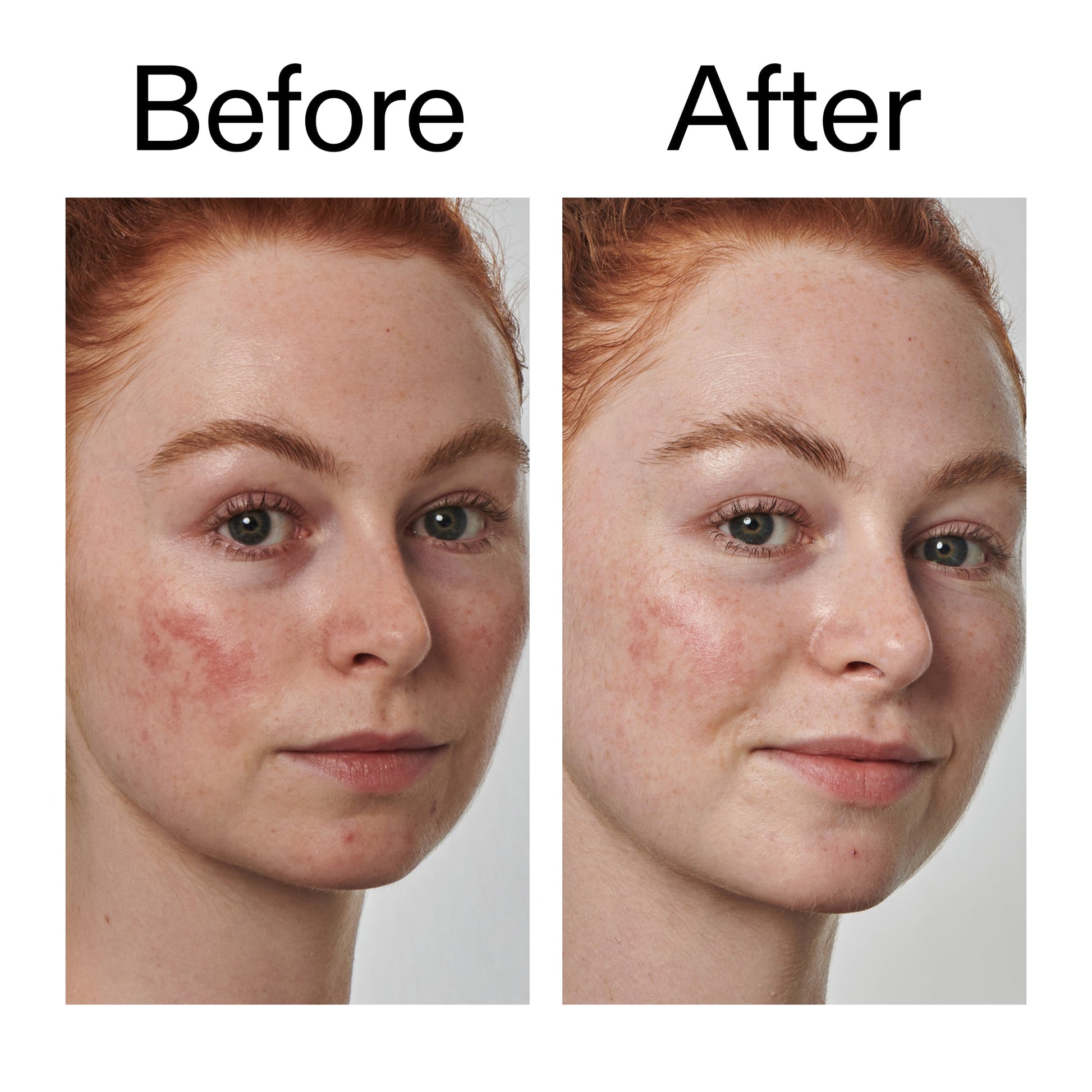 10-azelaic-acid-serum-for-redness-relief-d4 Redness_Relief_Serum_Before_After_2000x2000_3334dc9a-cce9-4e00-8aec-7ad89ca051f2.jpg