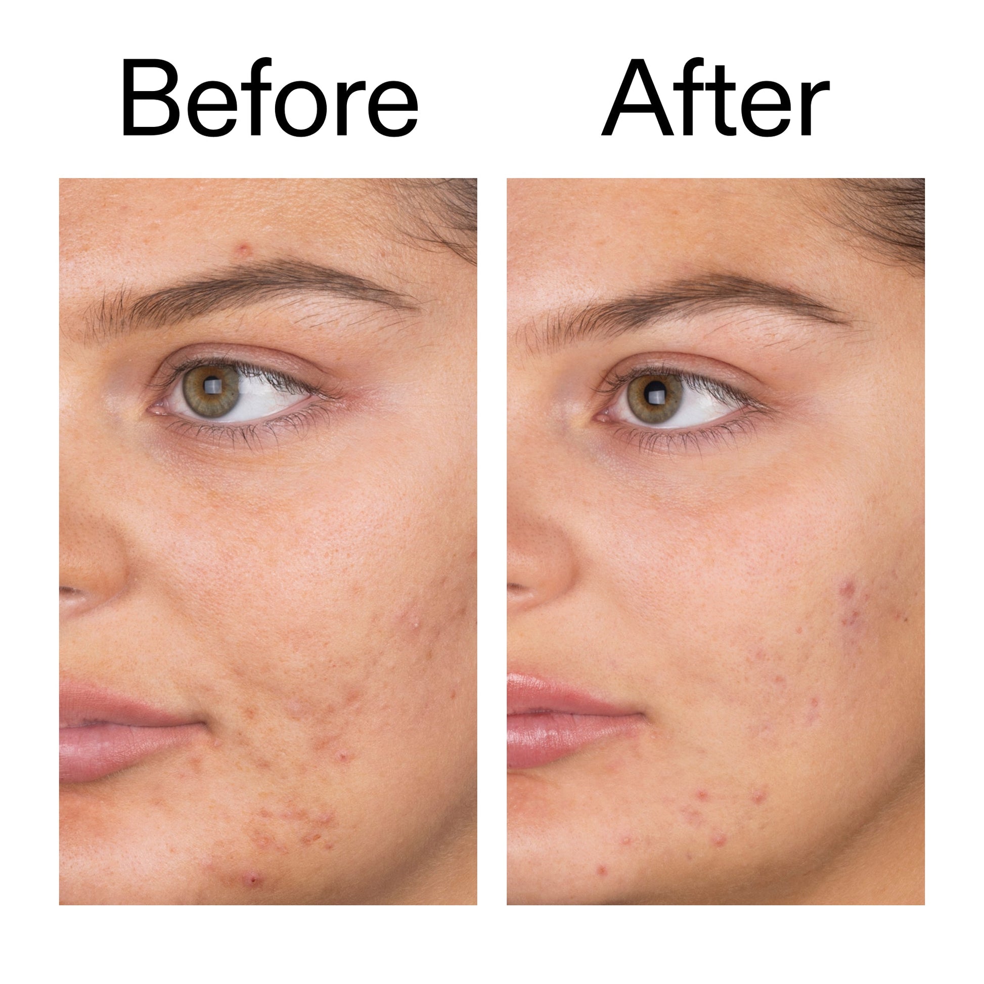 salicylic-acid-cleanser-150ml-z1 Salicylic_Acid_Cleanser_-_150ml_Before_After_2000x2000_e7230494-853f-4b07-82b1-27669104c995.jpg