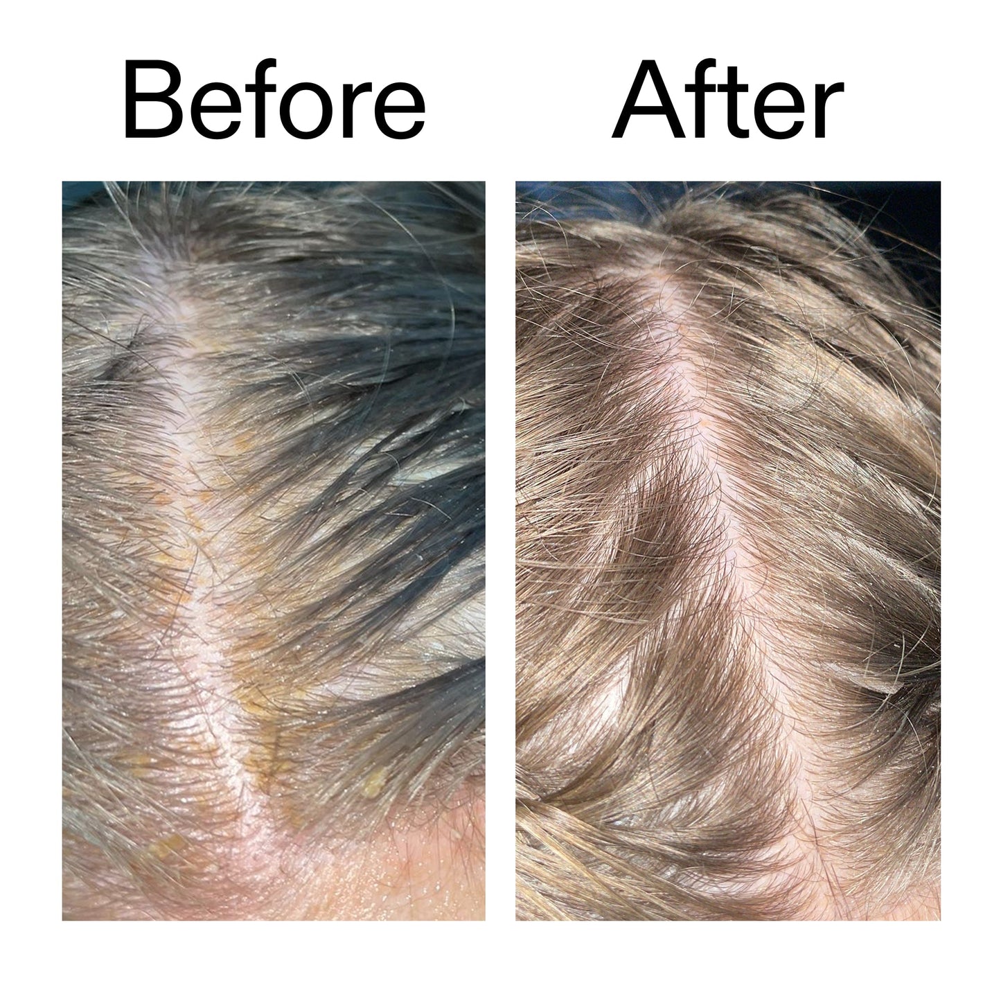 salicylic-acid-exfoliating-scalp-treatment-q1 Salicylic_Acid_Exfoliating_Scalp_Treatment_Before_After_2000x2000_e572a30f-057c-4a48-823b-1c09dc97f8d0.jpg
