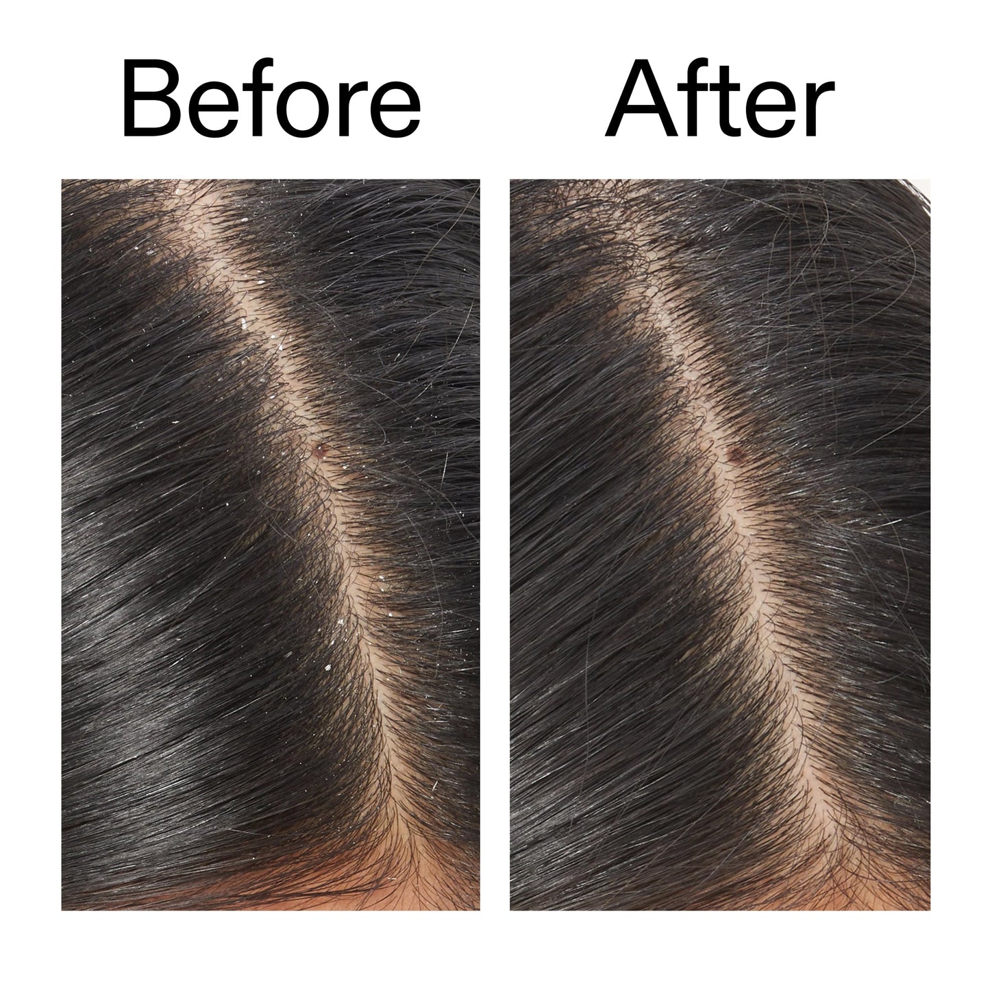 salicylic-acid-exfoliating-scalp-treatment-q1 Salicylic_Acid_Exfoliating_Scalp_Treatment_Before_After_V2_2000x2000_02bd61ad-42bf-490b-b3e3-7e04b2e8a673.jpg