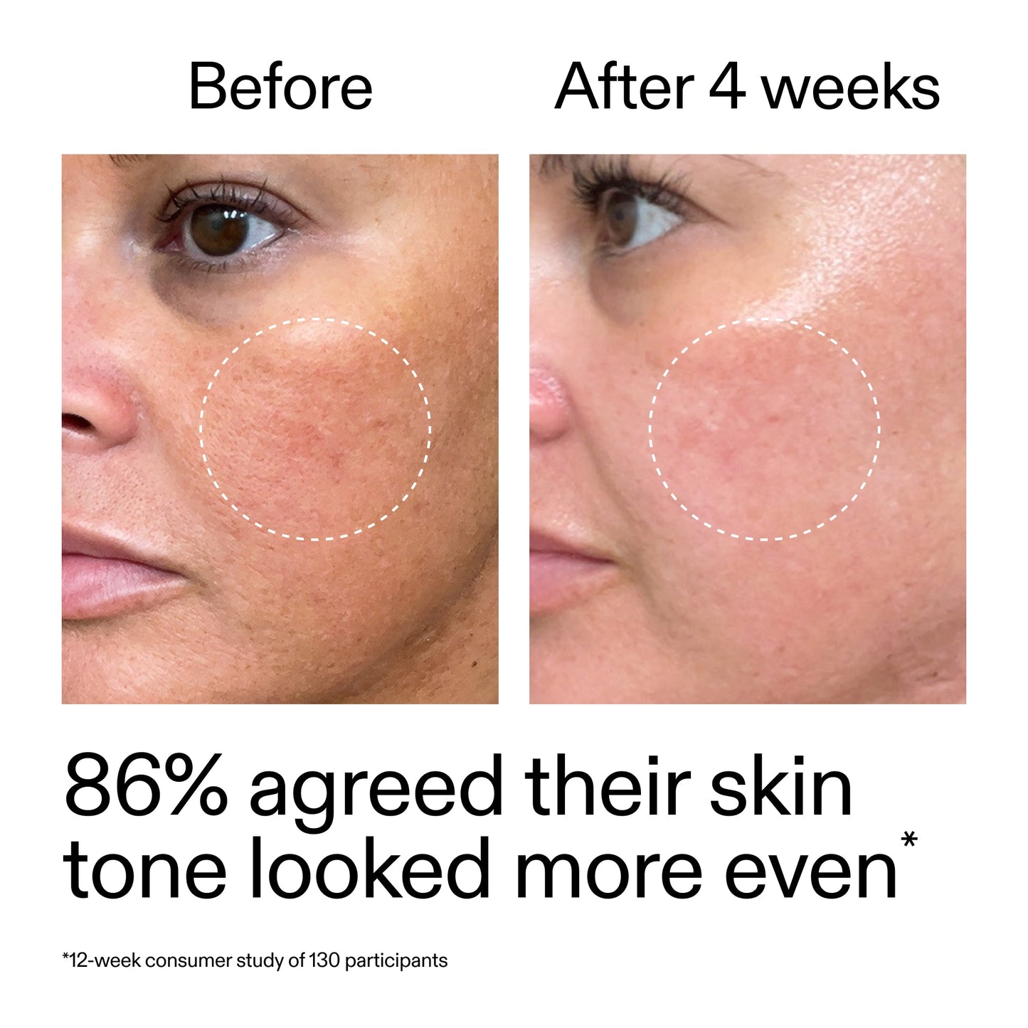 starter-retinol-serum-o2 StarterRetinol_BeforeAfter_Claim2_2000x2000_f5c9ecc0-8d76-429d-bef5-c3a61bcf5c09.jpg