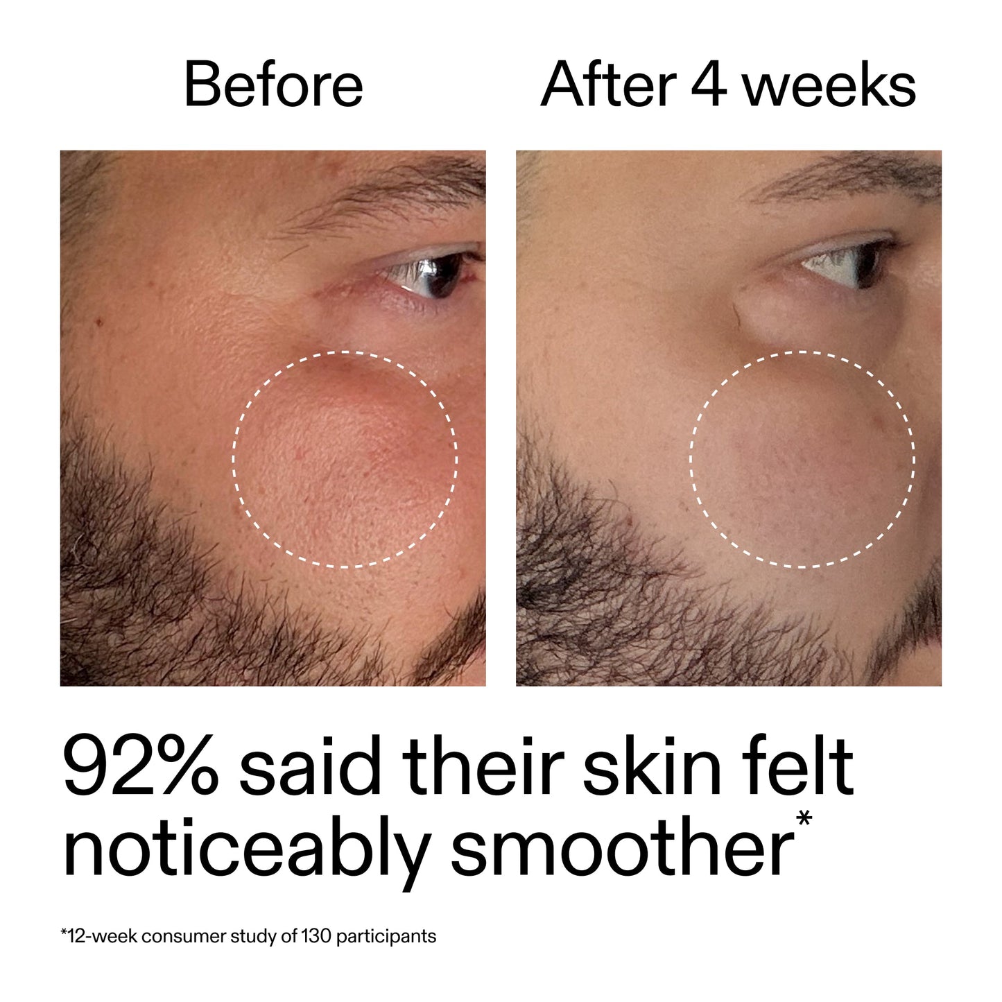 starter-retinol-serum-o2 StarterRetinol_BeforeAfter_Claim3_2000x2000_6ceab106-e0ee-4ed4-ba62-41bc39538038.jpg