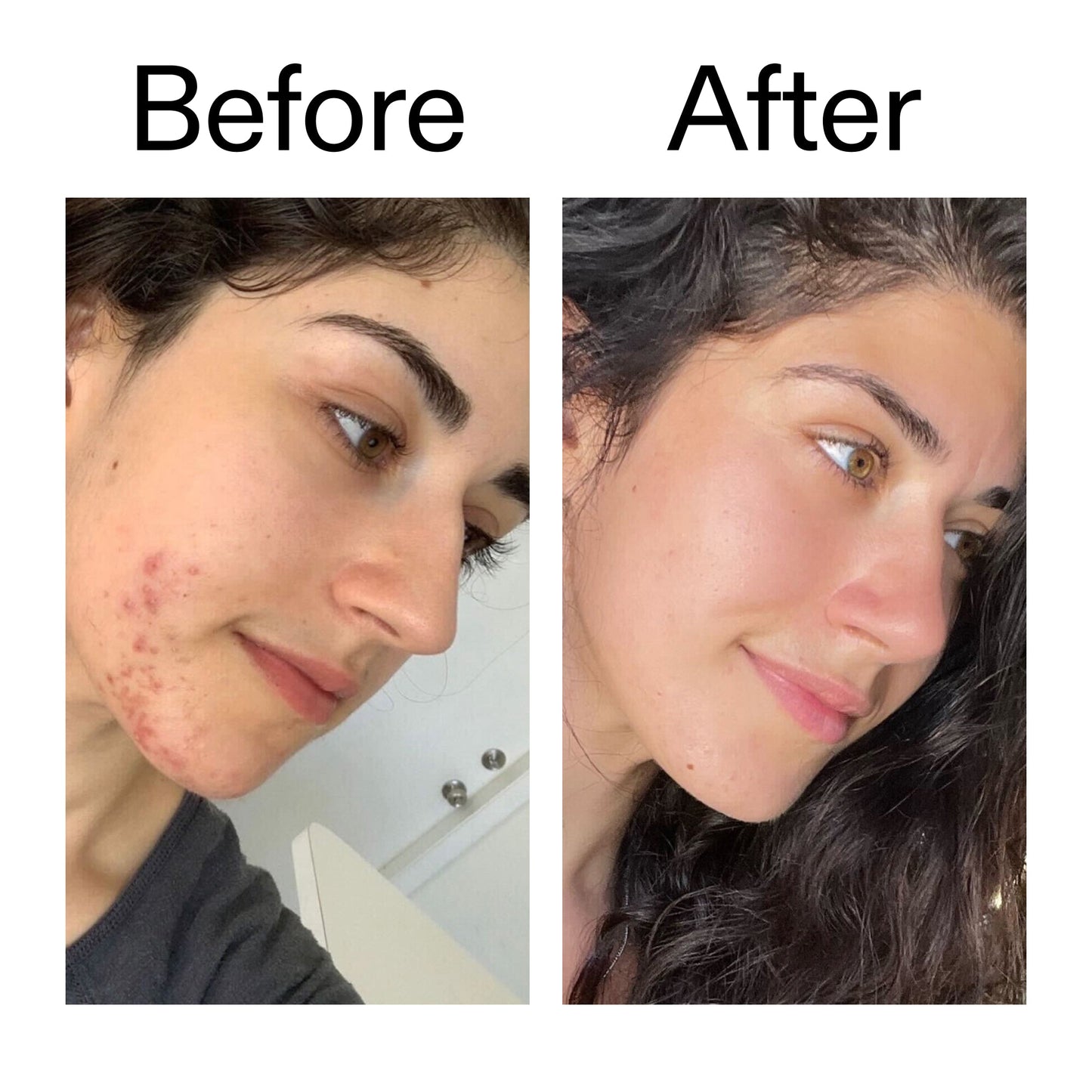 succinic-acid-acne-treatment-u5 Succinic_Acid_Treatment_Before_After_2000x2000_6a5f0054-2f58-4433-9314-0dc72c9bdd3b.jpg