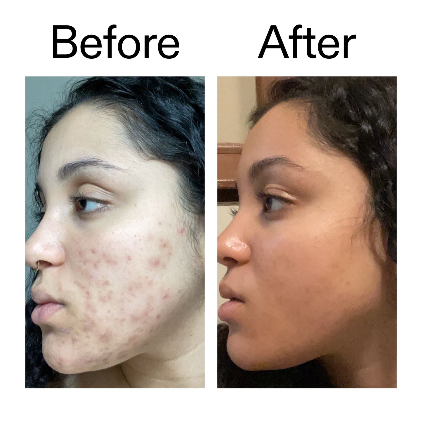 tranexamic-acid-serum-f6 Tranexamic_Acid_Serum_Before_After_2000x2000_98ebc8be-77b0-4843-8a22-90790ebe918b.jpg